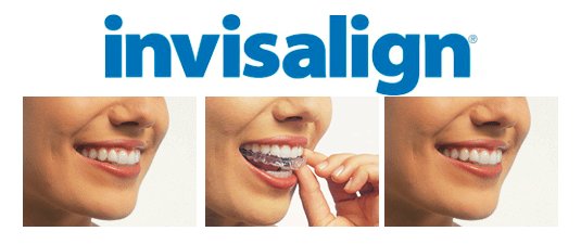 Invisalign